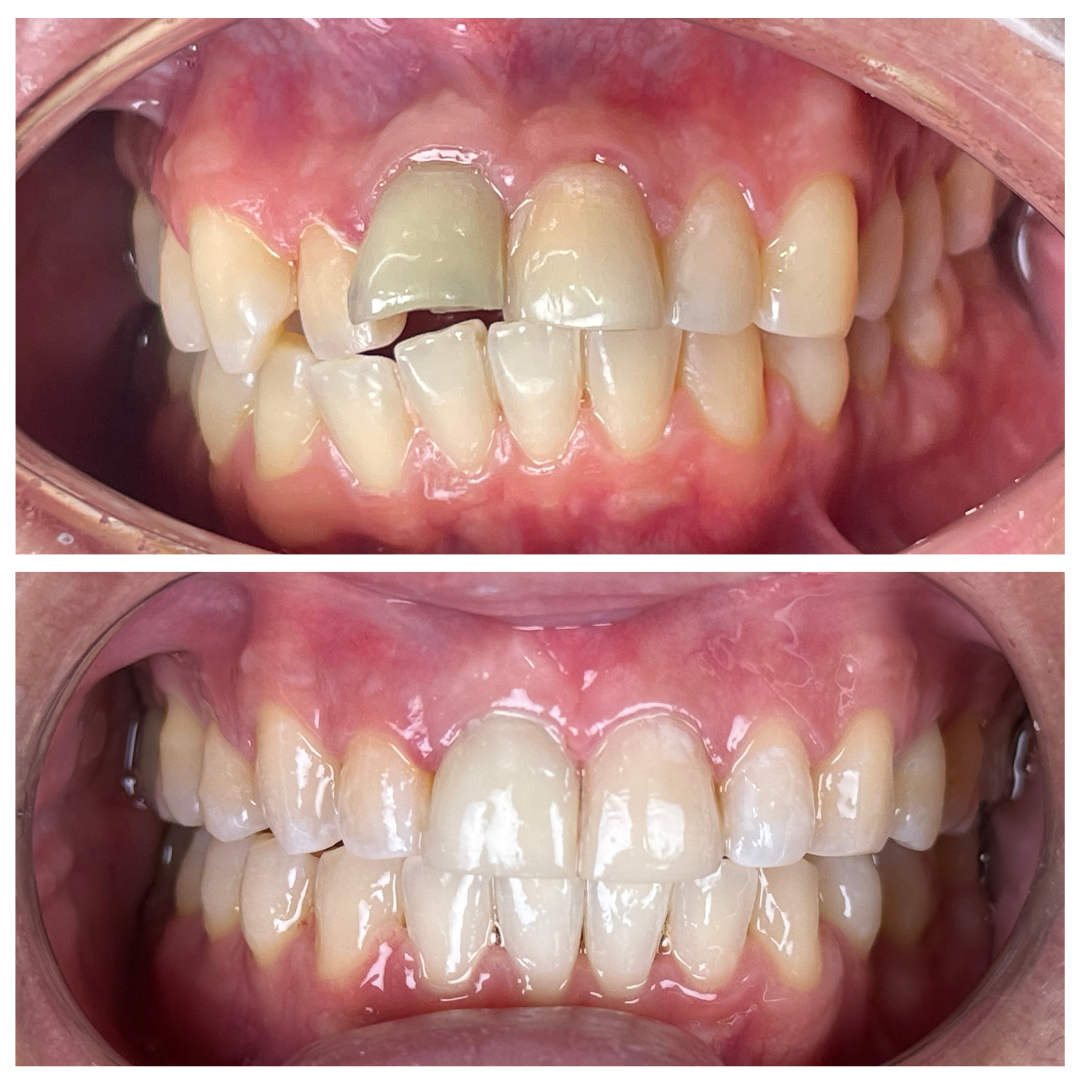 Self Ligating Braces